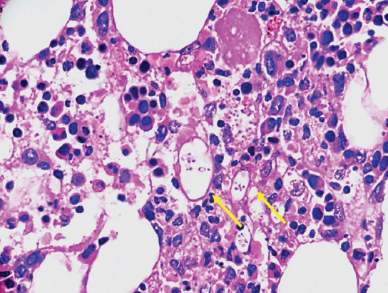 Bone marrow biopsy (PAS, ×20) with several histiocytes showing PAS positive intracellular small yeast forms having round or crescent-shaped nuclei and pericellular halo (yellow arrows) suggestive of histoplasmosis.